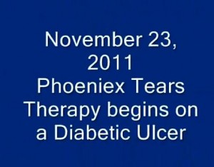 Therapy Begins On A Diabetic Ulcer