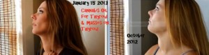 Cannabis Oil Treatment Shrinking Inoperable Masses