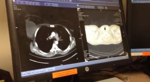 CT SCANS of a Stg 4 Breast Cancer Patient treated with CANNABIS OIL