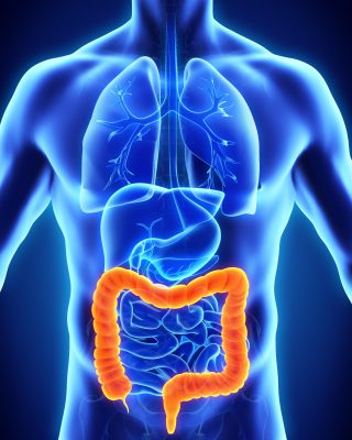 Colon Cancer