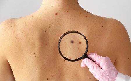 Melanoma