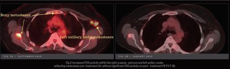 Case study: Remission of metastatic breast cancer may have been due to use of cannabis oil and magic mushrooms